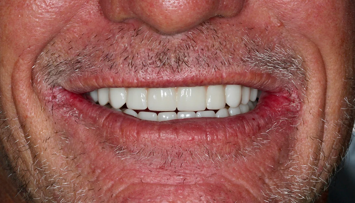 Before and After - Case 05 - A