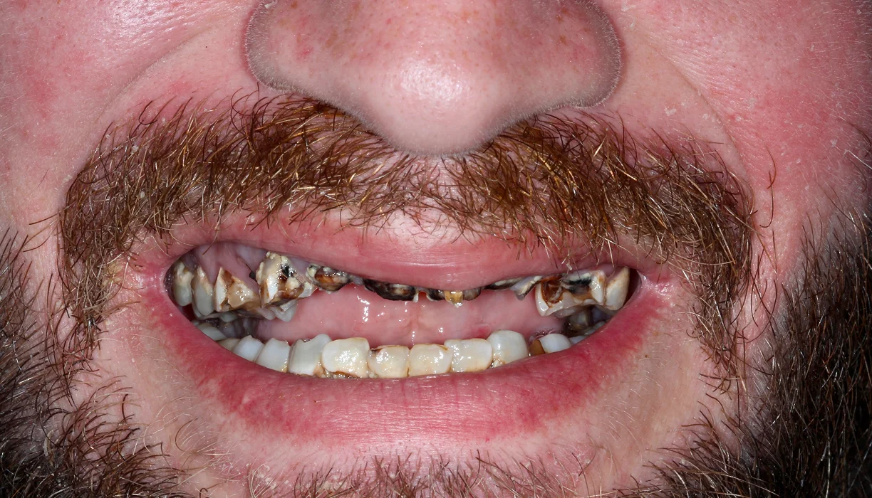 Before and After - Case 06 - B