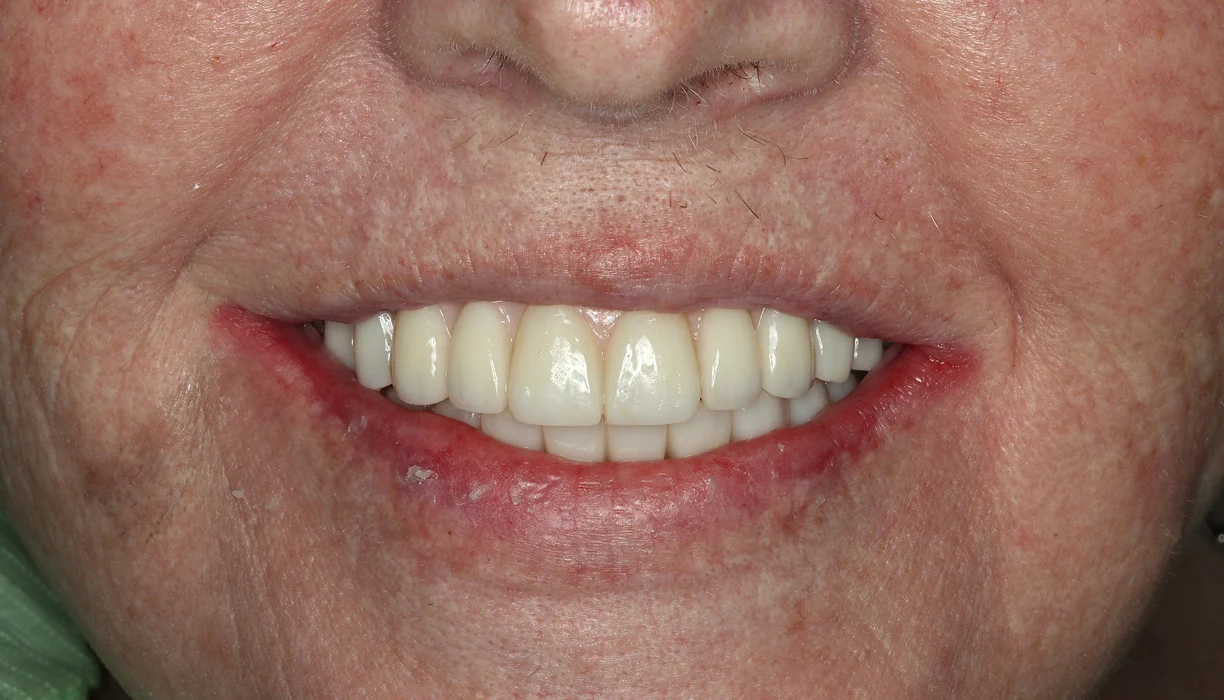 Before and After - Case 10 - A