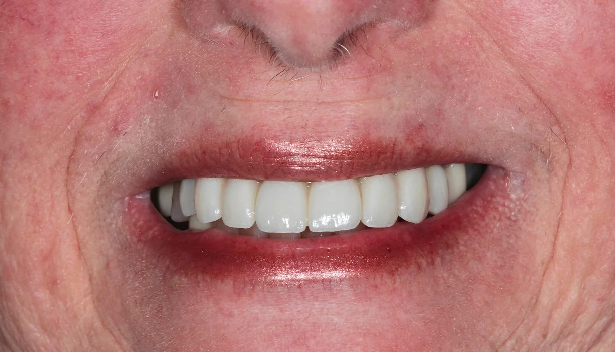 Before and After - Case 12 - A