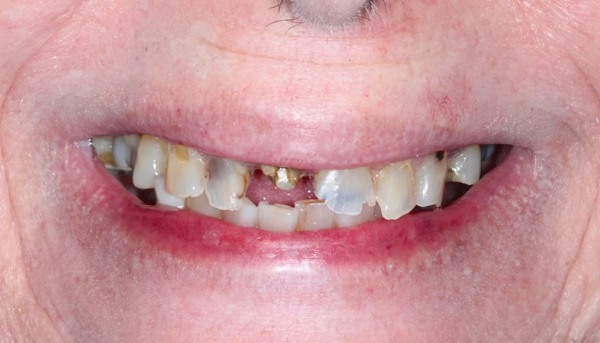 Before and After - Case 12 - B