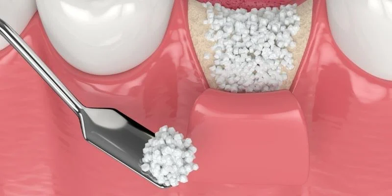 Bone Grafting Procedures and Techniques