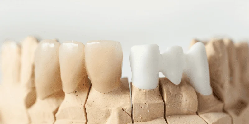 Dental Implants vs Bridges and Dentures