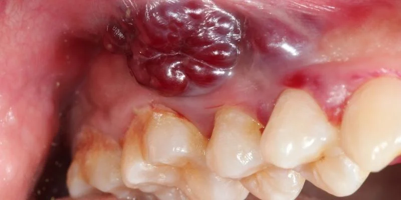 Oral Cancer