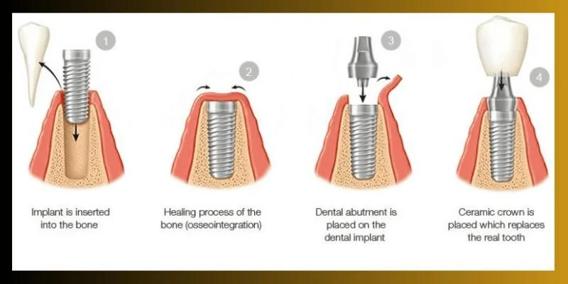 Overview of the Dental Implant Process