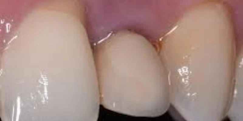 Peri Implantitis