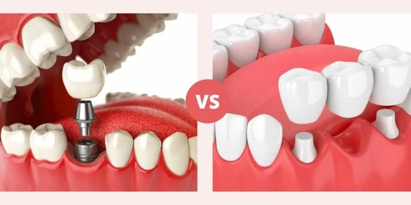 Single Tooth Implant vs Bridge