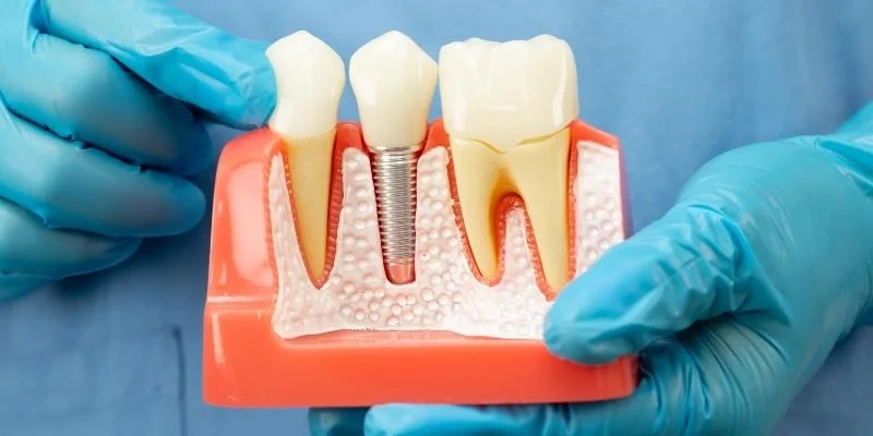 What Is a Single Tooth Implant