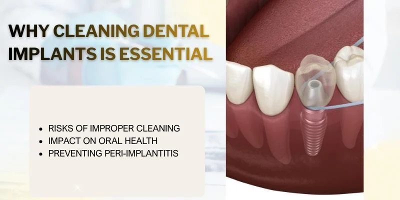 Why Cleaning Dental Implants Is Essential