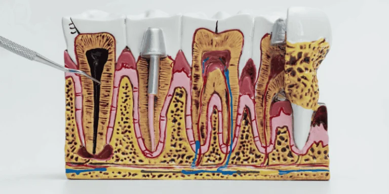 bone loss after tooth extraction