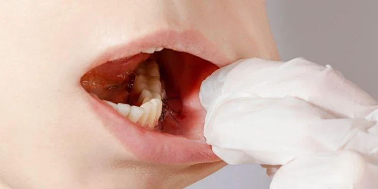 gum grafting for recession